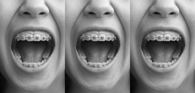 Everything Parents Should Know About Children’s Braces