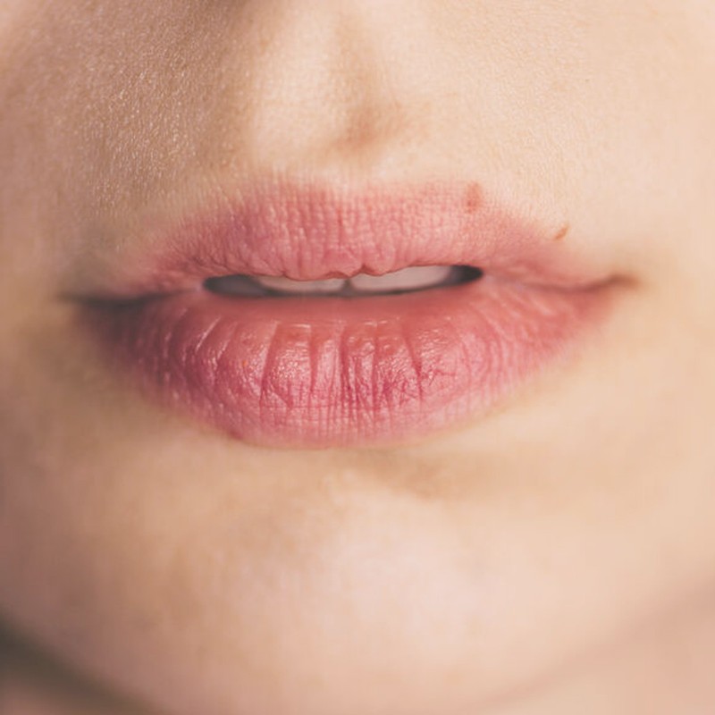 How To Treat Cold Sores