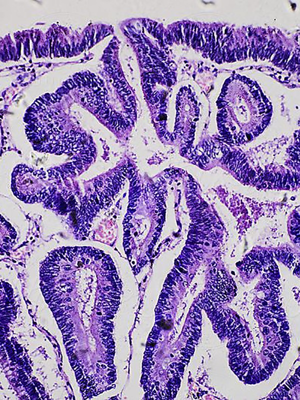 Could SIBO Be The Real Cause Of IBS?