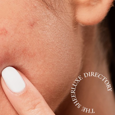 The SL Directory: Acne Experts