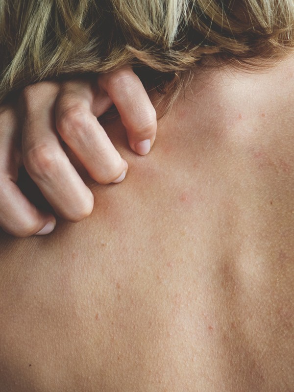 What You Need To Know About Histamine Intolerance