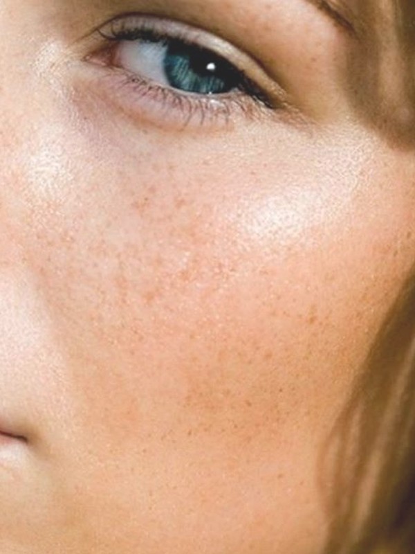 How To Treat Spot-Prone Skin