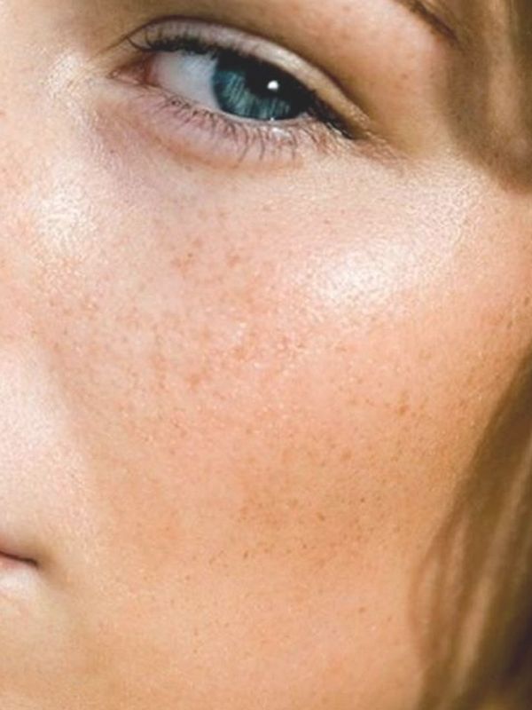 How To Treat Spot-Prone Skin