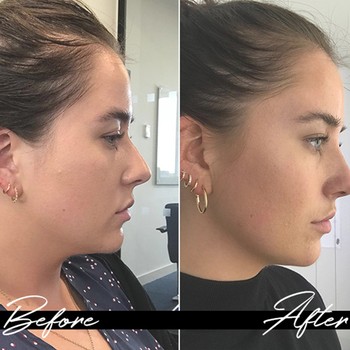 Here’s Why You Should Consider A Non-Surgical Nose Job 