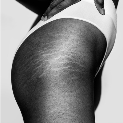 Everything You Need To Know About Stretch Marks