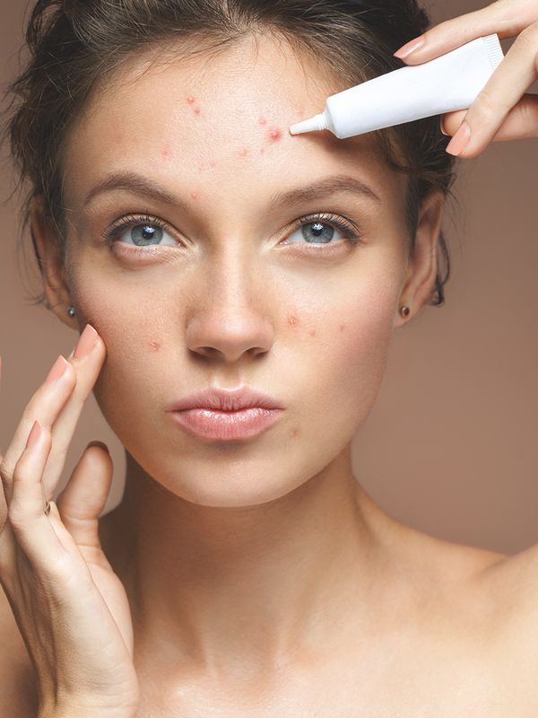 Everything You Need To Know About Adult Acne 
