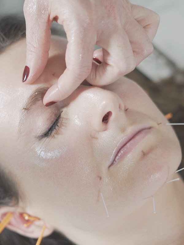  Extreme Beauty: Facial Acupuncture