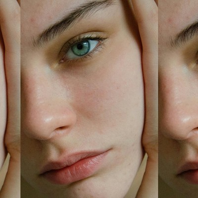 What You Need To Know About Rosacea & How To Treat It