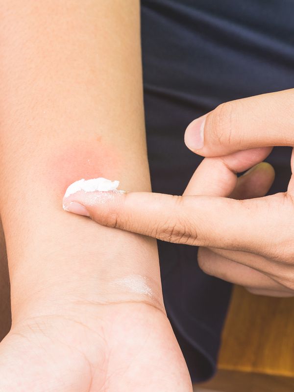 How To Deal With Insect Bites & Stings This Summer