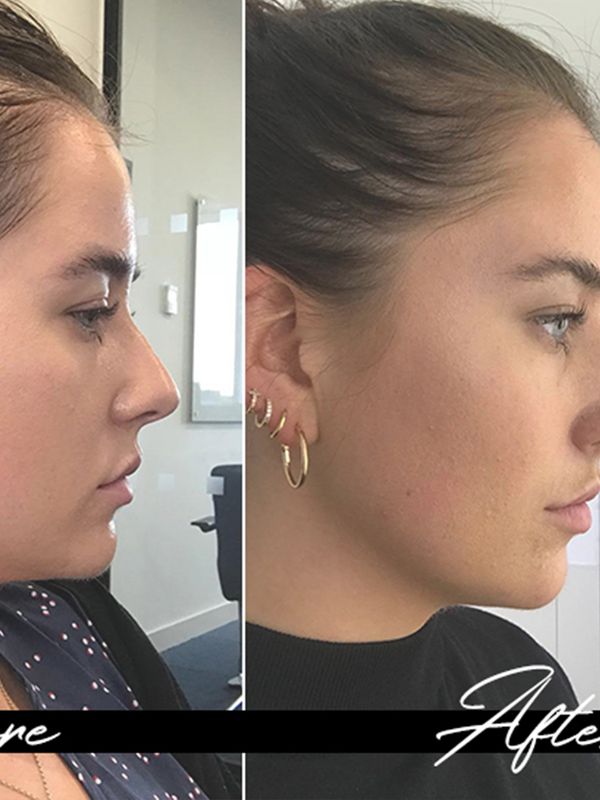 Here’s Why You Should Consider A Non-Surgical Nose Job 