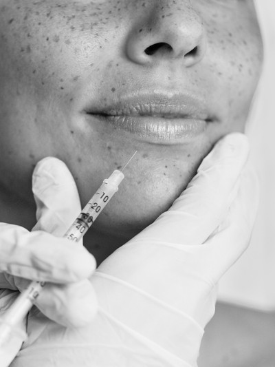 A Comprehensive & Honest Guide To Lip Filler