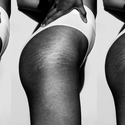 Are stretch marks keeping you from wearing that two piece?: D'Allure  Medspa: Medical Spa