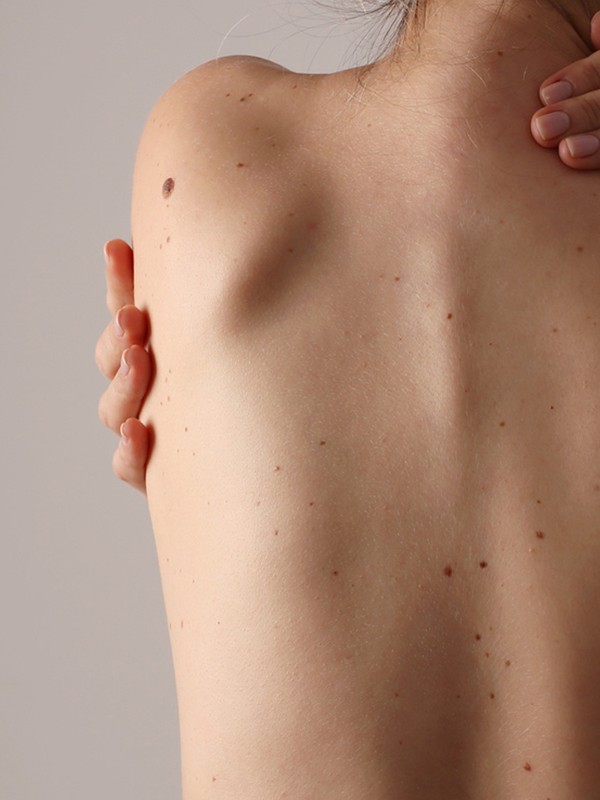  Why You Should Be Checking Your Moles 