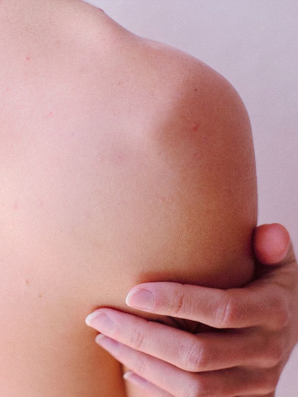 Back Acne: How To Treat & Prevent It 