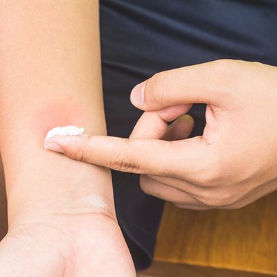 How To Deal With Insect Bites & Stings This Summer