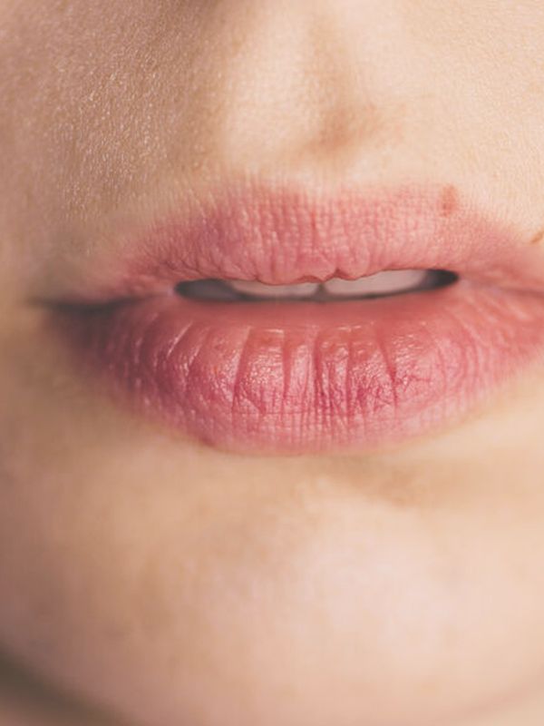 How To Treat Cold Sores