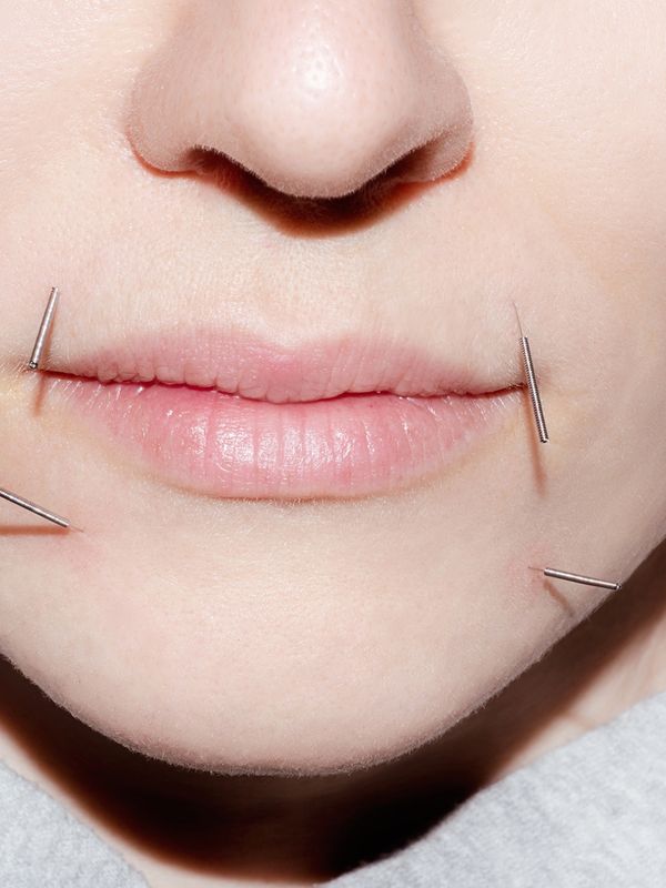 What You Need To Know About Acupuncture