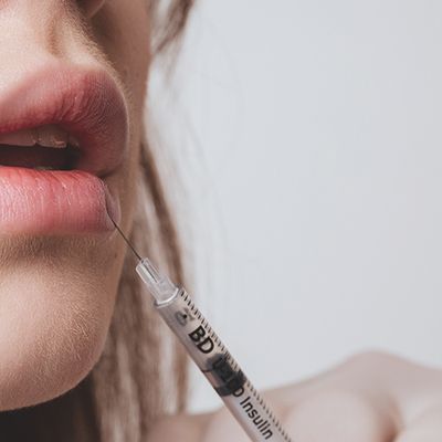 What It's Like To Have Lip Fillers Removed
