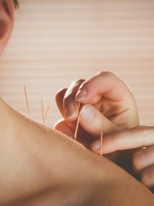 My Interesting Job: Acupuncturist
