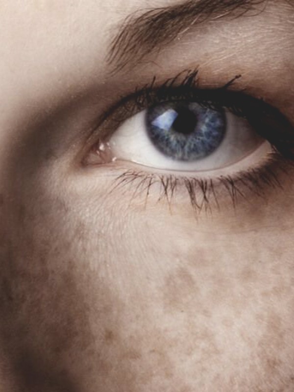 9 Things You Need To Know About Melasma