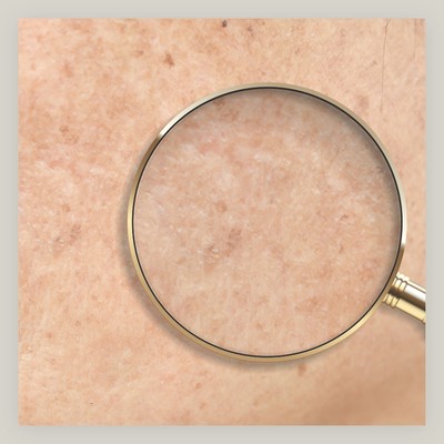 Dark Spots: What They Are, Why They Occur & How To Treat Them 