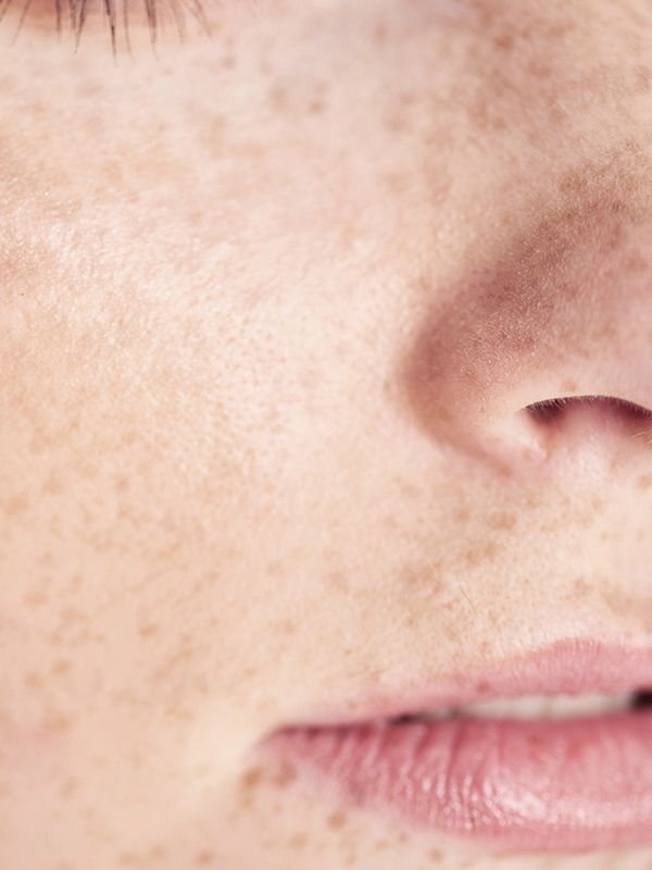Moles Vs. Freckles: What’s The Difference? 