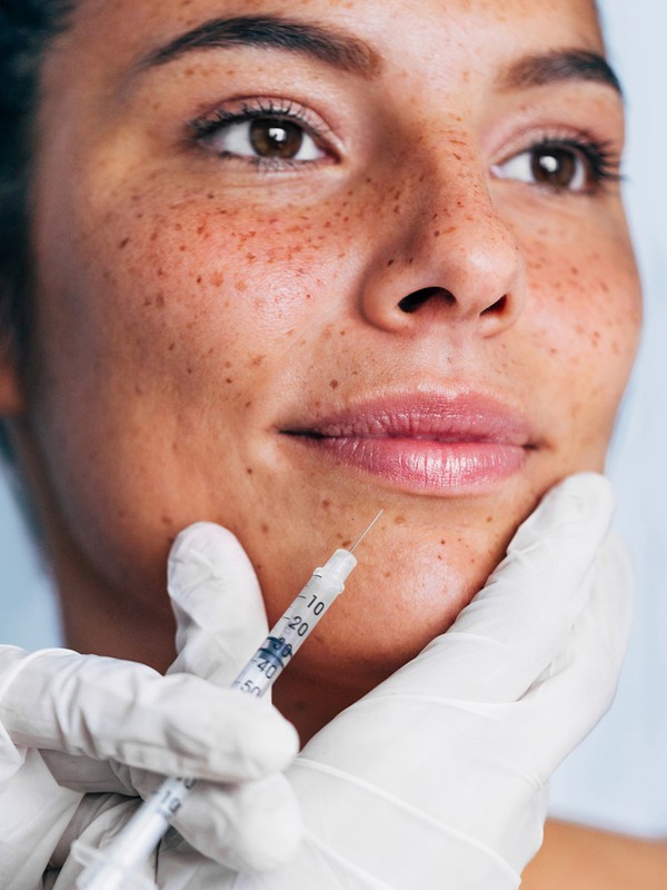 What You Should Know About HA Dermal Fillers