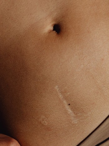 A Complete Guide To Treating Scars 