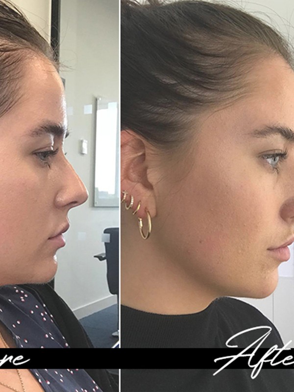 Here’s Why You Should Consider A Non-Surgical Nose Job 