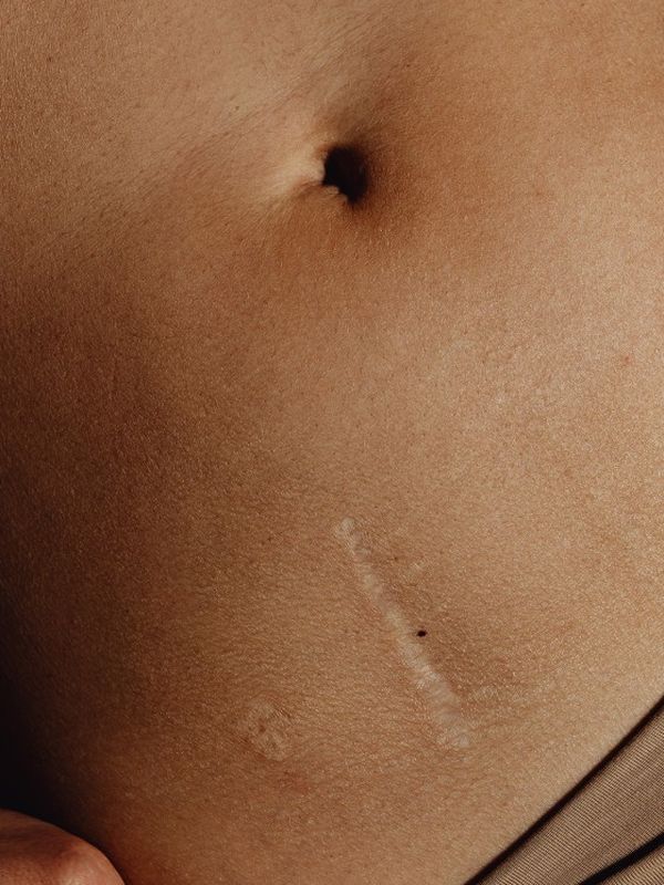 A Complete Guide To Treating Scars 