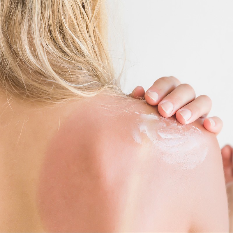 How To Soothe & Heal Sunburn Fast