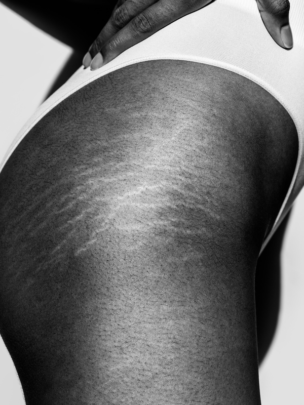 Everything You Need To Know About Stretch Marks