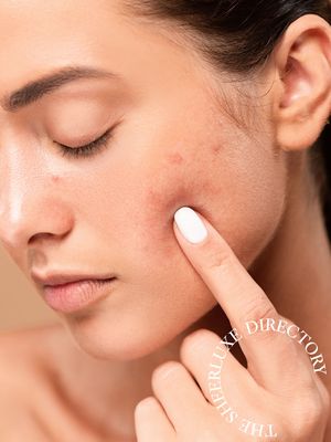 The SL Directory: Acne Experts