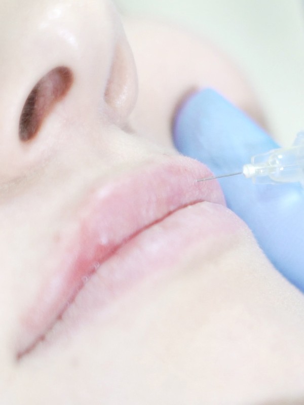 Extreme Beauty: First Time Lip Fillers