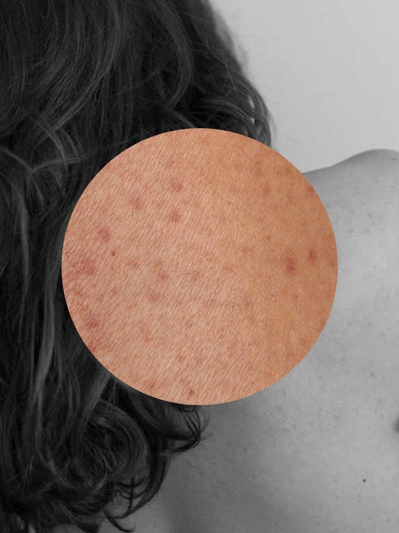 The Tips, Treatments & Best Products For Treating Keratosis Pilaris