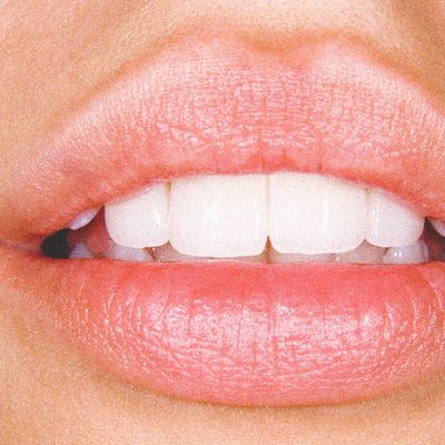 Invisalign: What You Need To Know