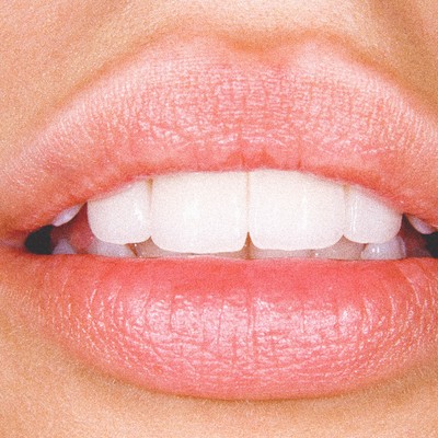 Invisalign: What You Need To Know