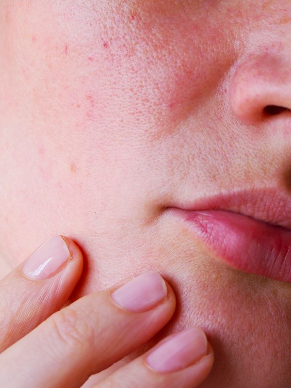 Rosacea: What It Is & How To Treat It 