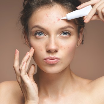 Everything You Need To Know About Adult Acne 