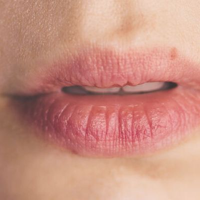 How To Treat Cold Sores