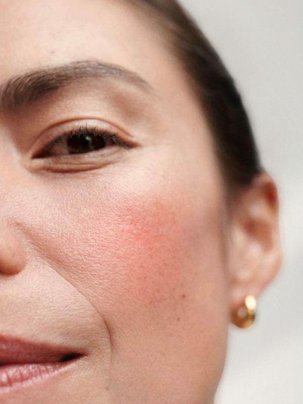 Rosacea 101: What It Is & How To Treat It