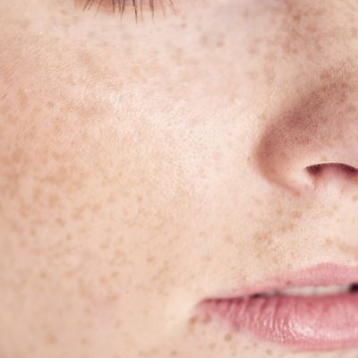 Moles Vs. Freckles: What’s The Difference? 