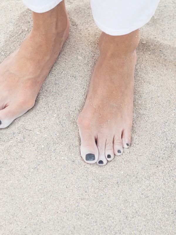 Bunions: Why Do They Occur & How To Treat Them