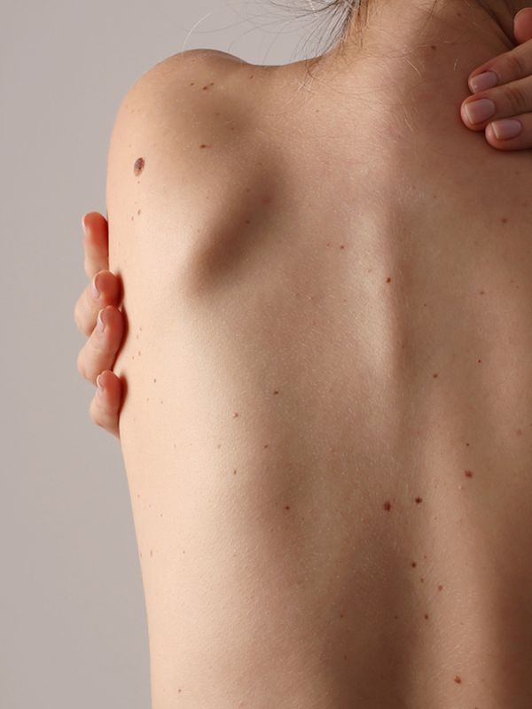  Why You Should Be Checking Your Moles 
