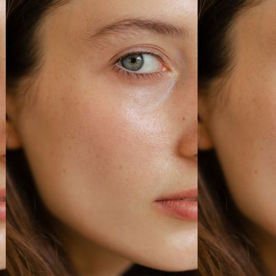 The Skin-Tightening Treatment Everyone’s Talking About 