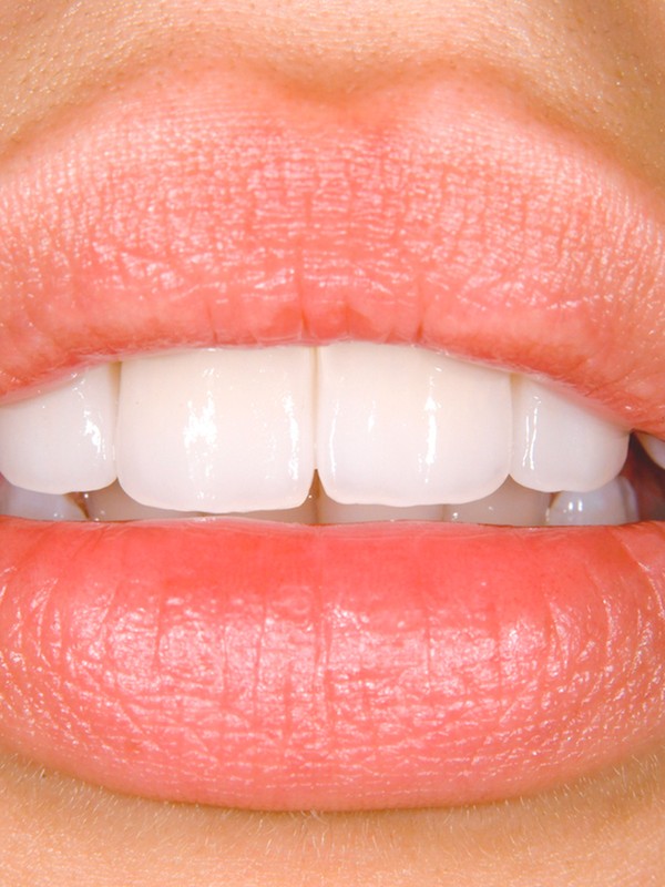 Everything You Need To Know About Veneers