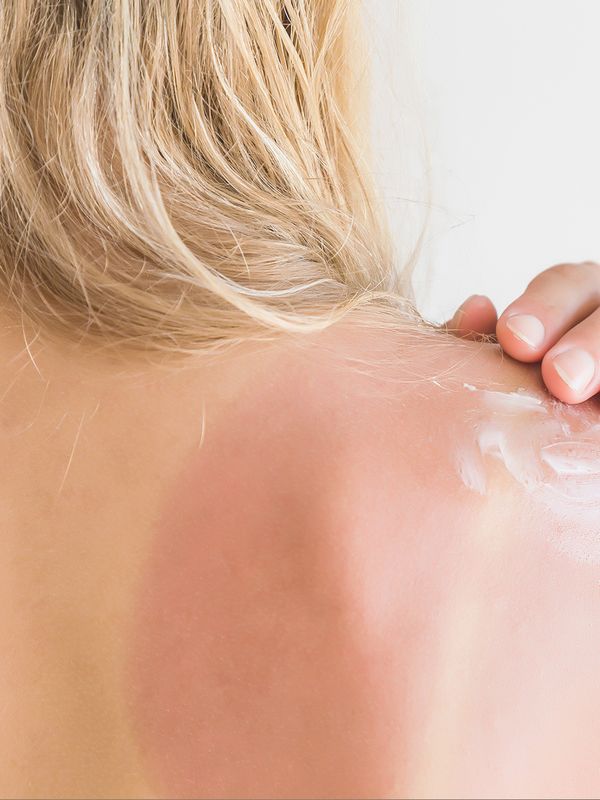 How To Soothe & Heal Sunburn Fast
