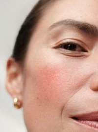 Rosacea 101: What It Is & How To Treat It