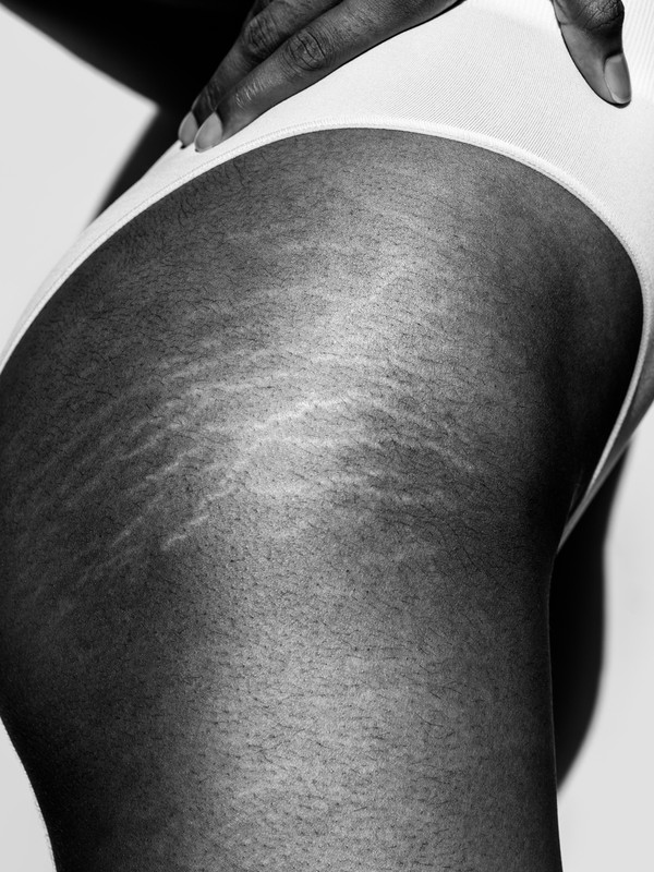 Stretch Marks & Weight Loss: Everything You Need To Know - SOG