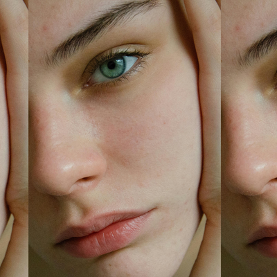 What You Need To Know About Rosacea & How To Treat It 